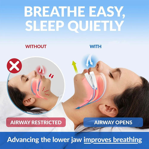 Snore No More — Anti-Snoring Mouthpiece by Silent Nights